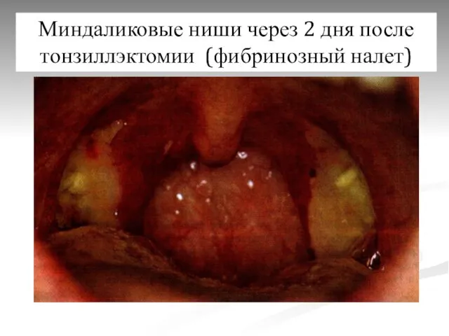 Миндаликовые ниши через 2 дня после тонзиллэктомии (фибринозный налет)