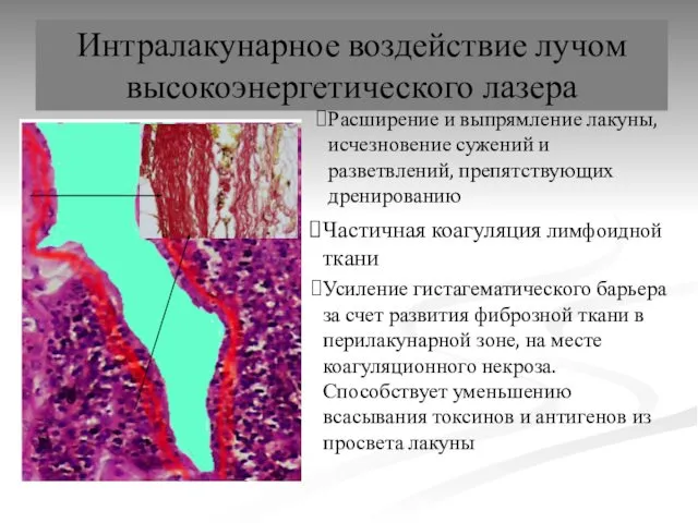 Интралакунарное воздействие лучом высокоэнергетического лазера Расширение и выпрямление лакуны, исчезновение сужений