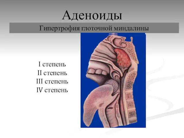 Аденоиды Гипертрофия глоточной миндалины I степень II степень III степень IV степень