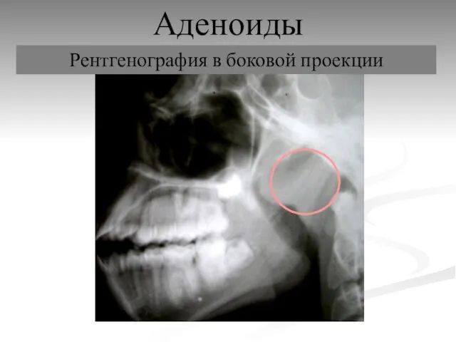 Аденоиды Рентгенография в боковой проекции