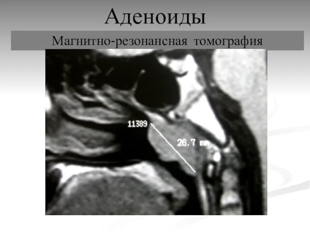 Аденоиды Магнитно-резонансная томография