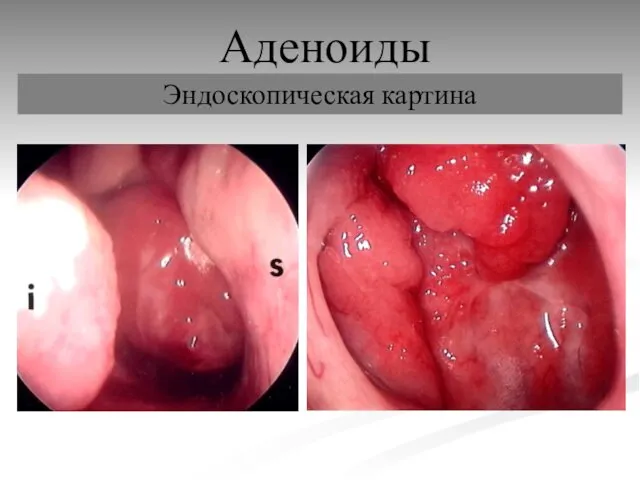 Аденоиды Эндоскопическая картина