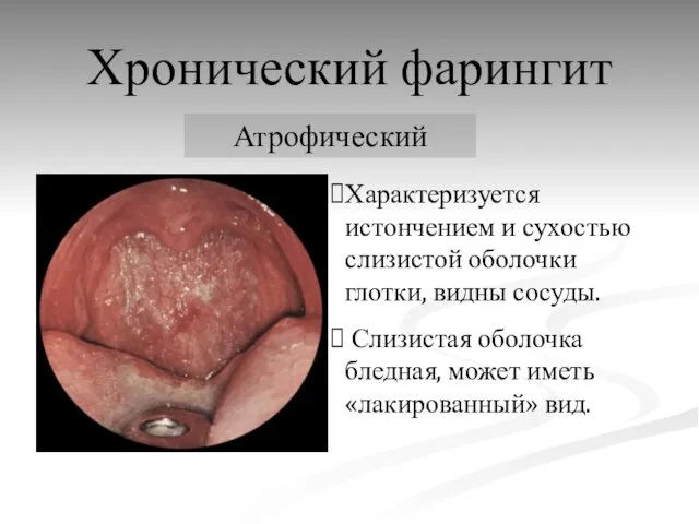 Хронический фарингит Атрофический Характеризуется истончением и сухостью слизистой оболочки глотки, видны