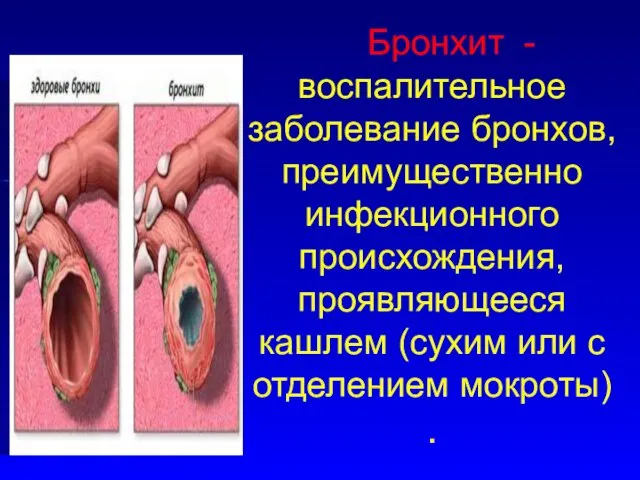 Бронхит - воспалительное заболевание бронхов, преимущественно инфекционного происхождения, проявляющееся кашлем (сухим или с отделением мокроты) .