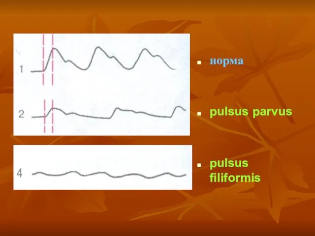норма pulsus parvus pulsus filiformis