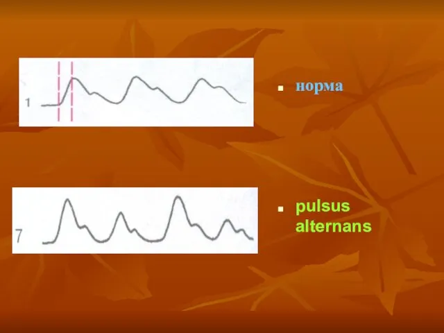 норма pulsus alternans