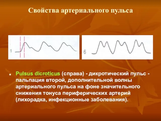 Свойства артериального пульса Pulsus dicroticus (справа) - дикротический пульс - пальпация