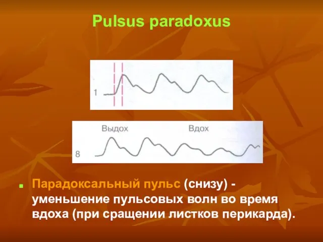 Pulsus paradoxus Парадоксальный пульс (снизу) - уменьшение пульсовых волн во время вдоха (при сращении листков перикарда).