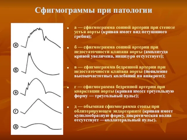 Сфигмограммы при патологии а — сфигмограмма сонной артерии при стенозе устья