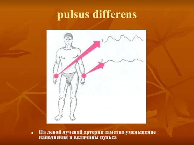 pulsus differens На левой лучевой артерии заметно уменьшение наполнения и величины пульса