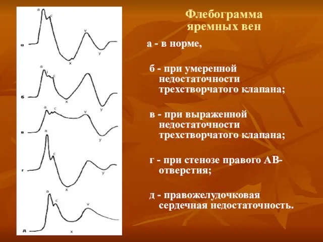 Флебограмма яремных вен а - в норме, б - при умеренной