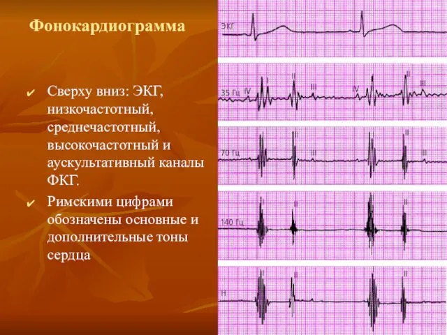 Фонокардиограмма Сверху вниз: ЭКГ, низкочастотный, среднечастотный, высокочастотный и аускультативный каналы ФКГ.