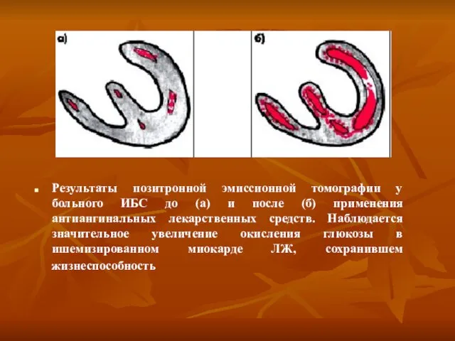 Результаты позитронной эмиссионной томографии у больного ИБС до (а) и после