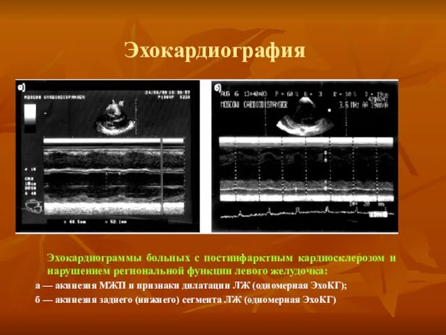 Эхокардиография Эхокардиограммы больных с постинфарктным кардиосклерозом и нарушением региональной функции левого