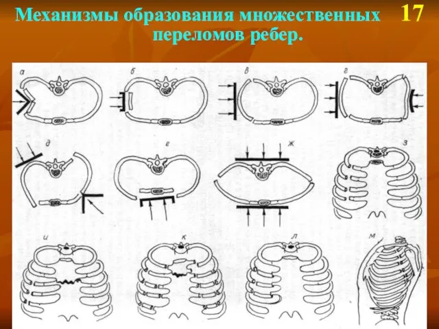 Механизмы образования множественных 17 переломов ребер.