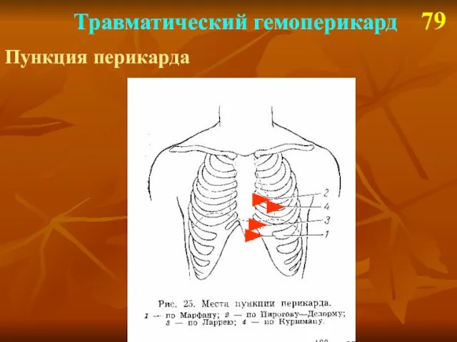 Травматический гемоперикард 79 Пункция перикарда