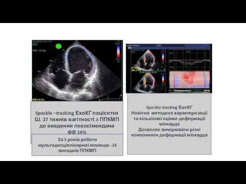 Speckle –tracking ЕхоКГ пацієнтки Ш. 27 тижнів вагітності з ППКМП до