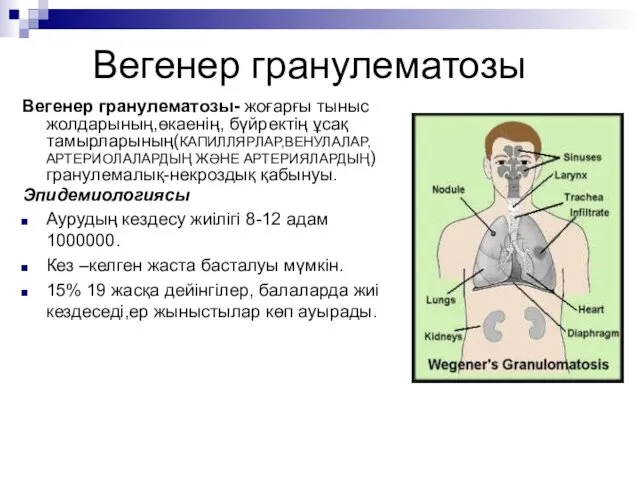 Вегенер гранулематозы Вегенер гранулематозы- жоғарғы тыныс жолдарының,өкаенің, бүйректің ұсақ тамырларының(КАПИЛЛЯРЛАР,ВЕНУЛАЛАР,АРТЕРИОЛАЛАРДЫҢ ЖӘНЕ