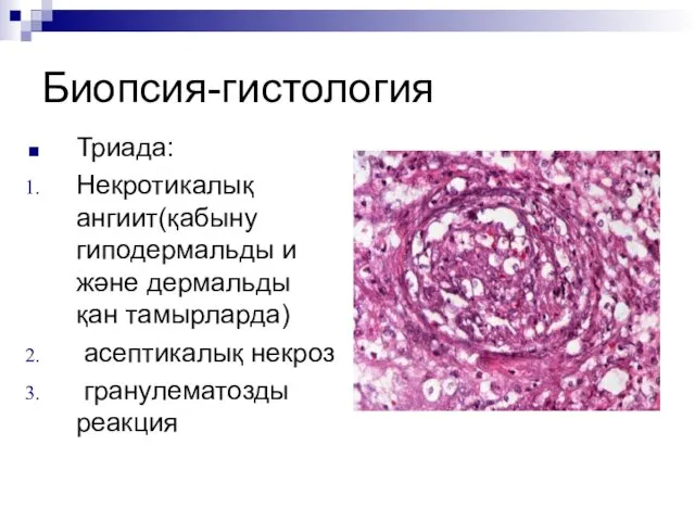 Биопсия-гистология Триада: Некротикалық ангиит(қабыну гиподермальды и және дермальды қан тамырларда) асептикалық некроз гранулематозды реакция