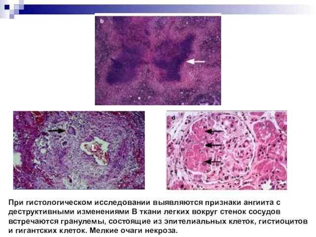 При гистологическом исследовании выявляются признаки ангиита с деструктивными изменениями В ткани