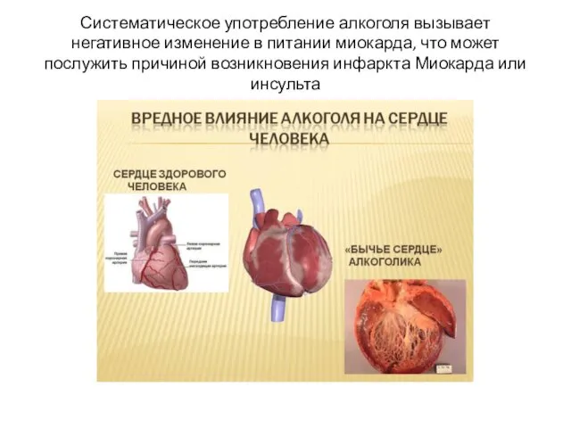 Систематическое употребление алкоголя вызывает негативное изменение в питании миокарда, что может