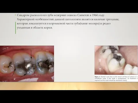 Синдром расколотого зуба вспервые описал Cameron в 1964 году. Характерной особенностью