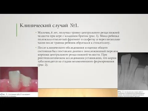 Клинический случай №1. Мальчик, 6 лет, получил травму центрального резца нижней