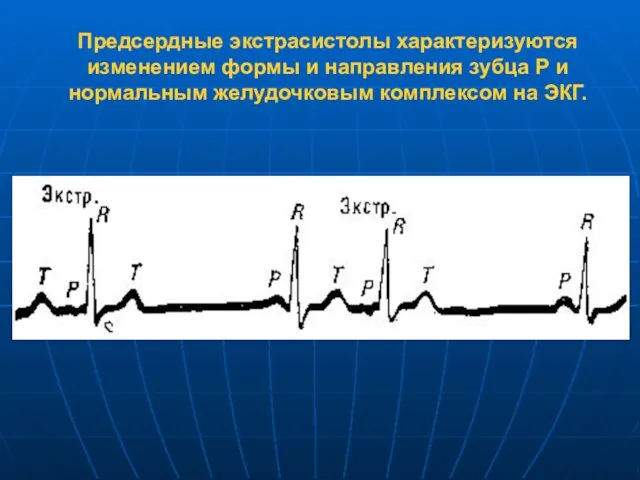 Предсердные экстрасистолы характеризуются изменением формы и направления зубца Р и нормальным желудочковым комплексом на ЭКГ.