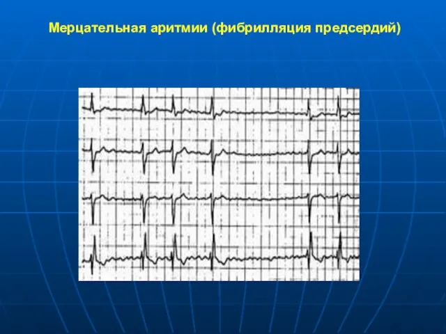 Мерцательная аритмии (фибрилляция предсердий)