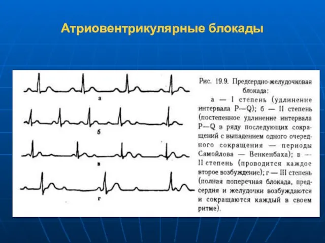 Атриовентрикулярные блокады