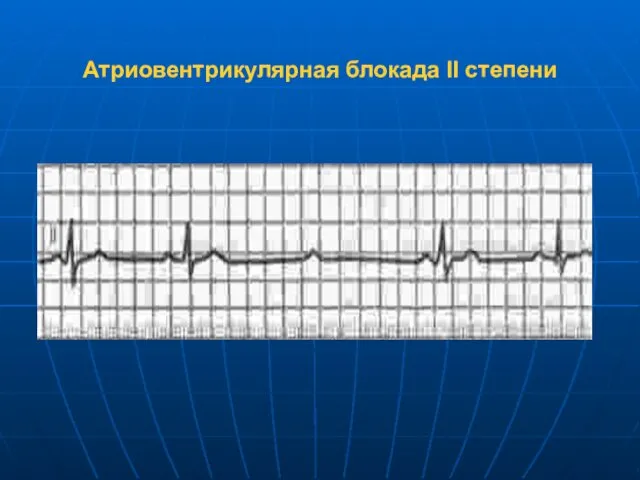 Атриовентрикулярная блокада II степени