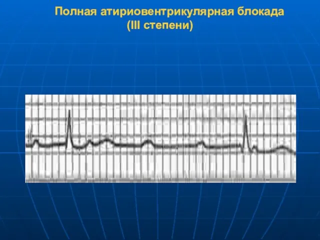 Полная атириовентрикулярная блокада (III степени)