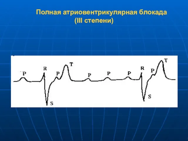 Полная атриовентрикулярная блокада (III степени)