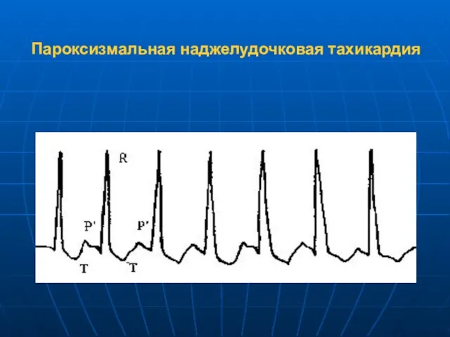 Пароксизмальная наджелудочковая тахикардия