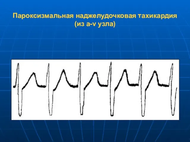 Пароксизмальная наджелудочковая тахикардия (из a-v узла)