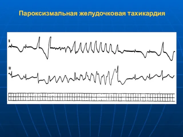 Пароксизмальная желудочковая тахикардия