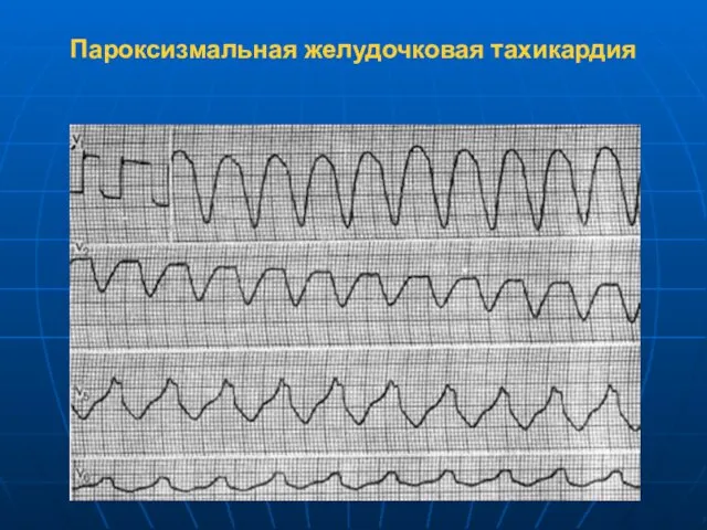 Пароксизмальная желудочковая тахикардия