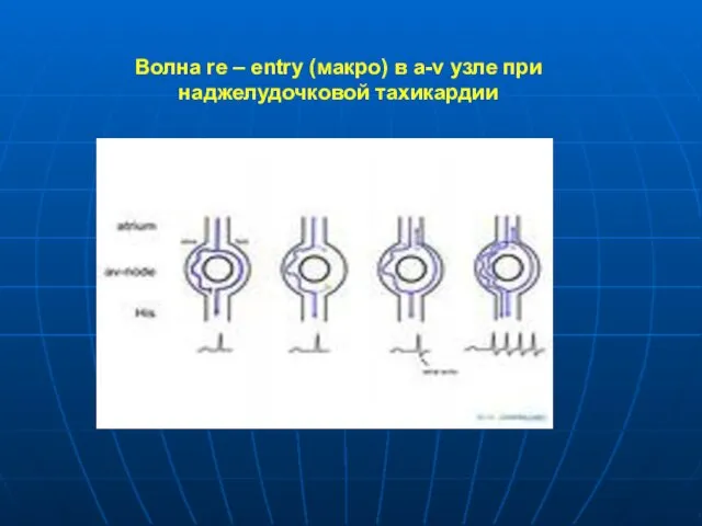 Волна re – entry (макро) в a-v узле при наджелудочковой тахикардии