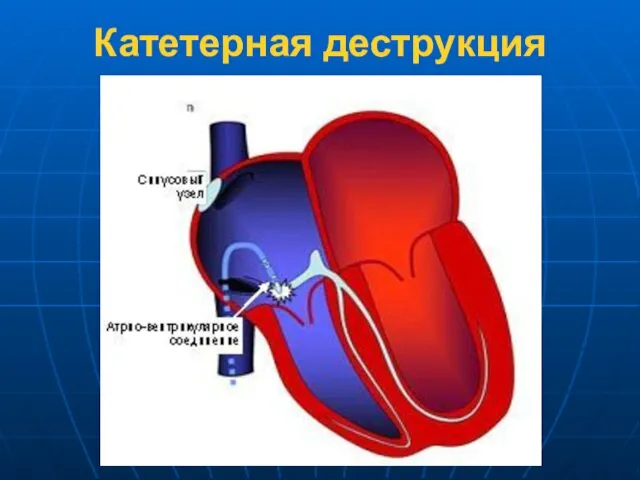 Катетерная деструкция