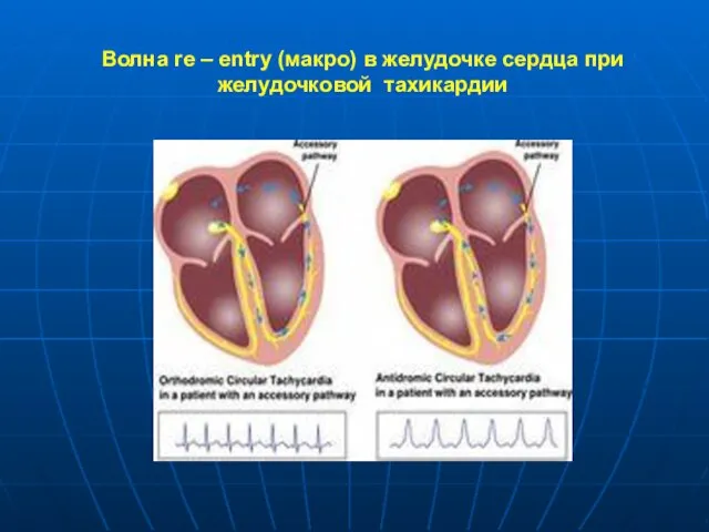 Волна re – entry (макро) в желудочке сердца при желудочковой тахикардии