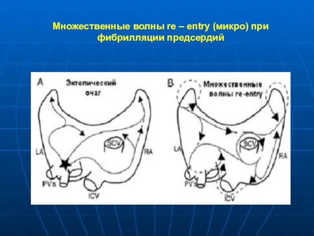 Множественные волны re – entry (микро) при фибрилляции предсердий