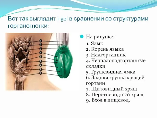 Вот так выглядит i-gel в сравнении со структурами гортаноглотки: На рисунке: