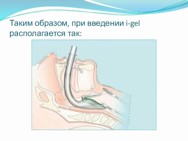 Таким образом, при введении i-gel располагается так: