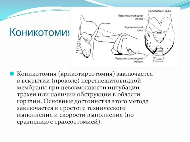 Коникотомия Коникотомия (крикотиреотомия) заключается в вскрытии (проколе) перстнещитовидной мембраны при невозможности