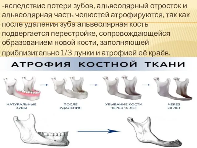 -вследствие потери зубов, альвеолярный отросток и альвеолярная часть челюстей атрофируются, так