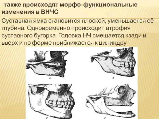 -также происходят морфо-функциональные изменения в ВНЧС Суставная ямка становится плоской, уменьшается