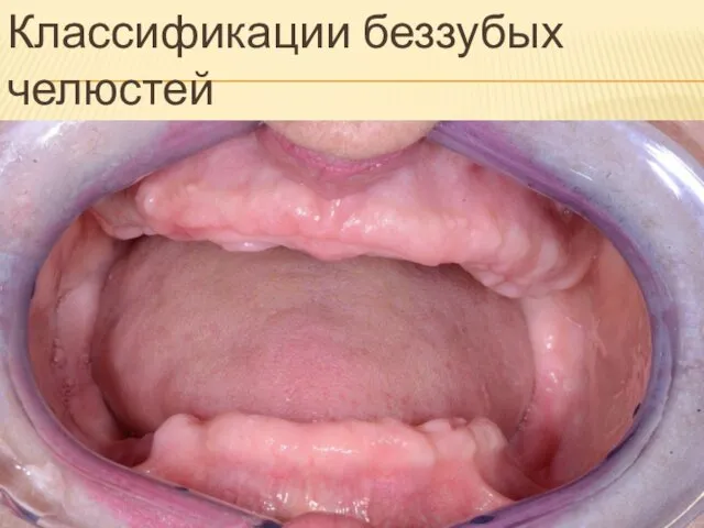 Классификации беззубых челюстей