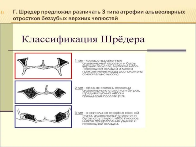 Г. Шредер предложил различать 3 типа атрофии альвеолярных отростков беззубых верхних челюстей