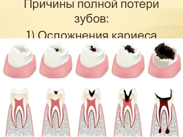 Причины полной потери зубов: 1) Осложнения кариеса