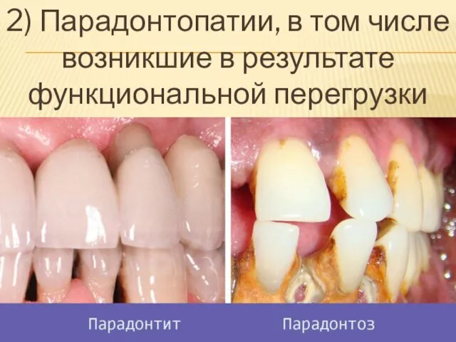 2) Парадонтопатии, в том числе возникшие в результате функциональной перегрузки